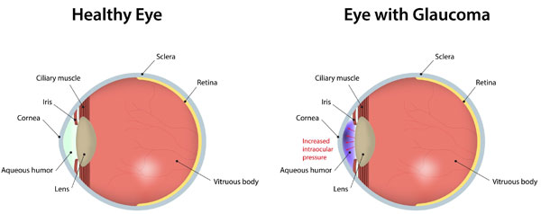 Glaucoma Updated